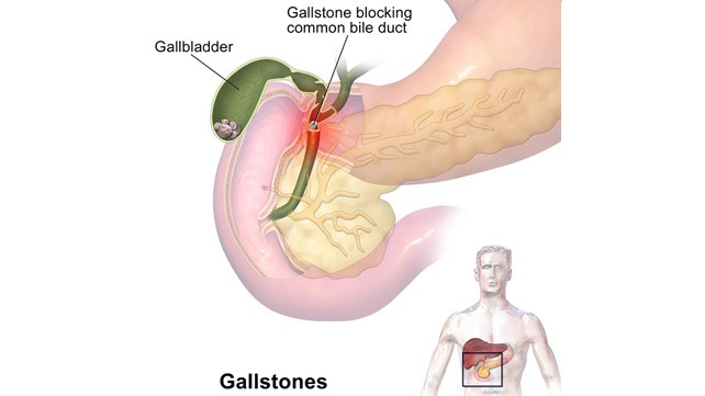 Gallbladder-stones